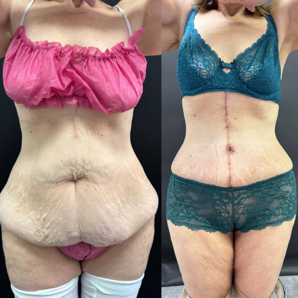 Пластика живота после бариатрической операции, фотография 4