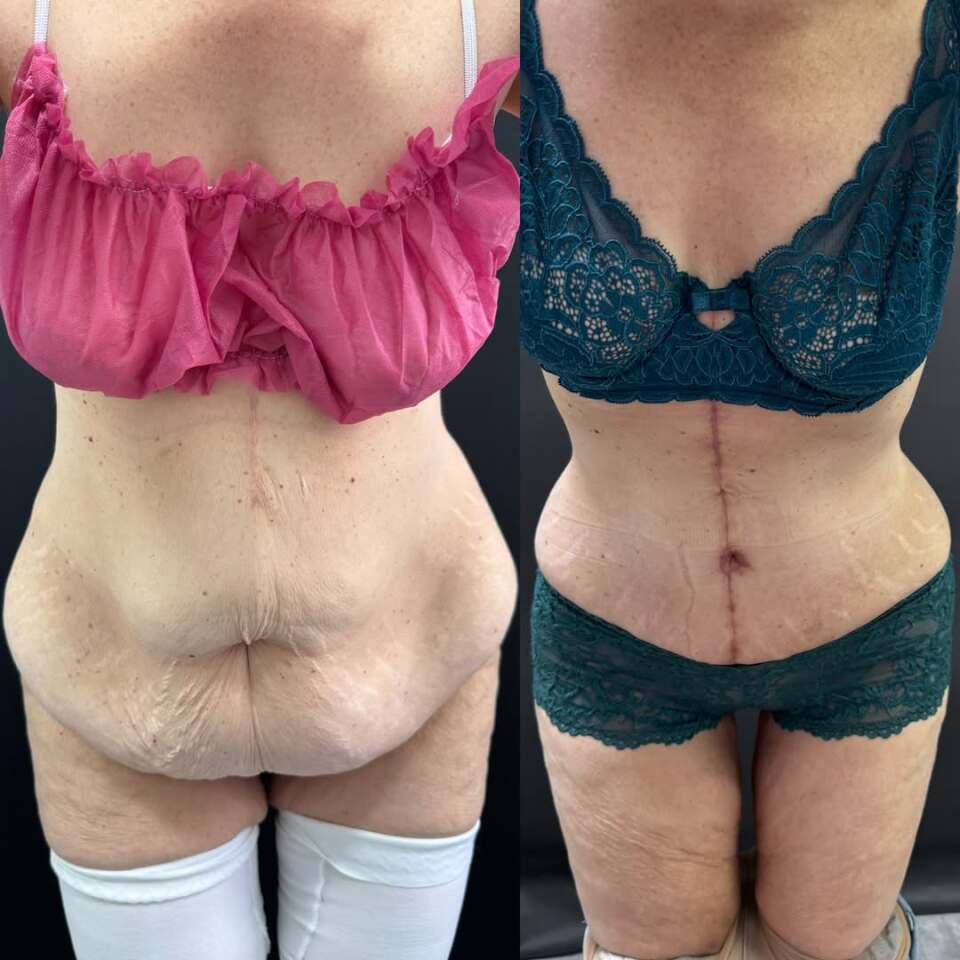 Пластика живота после бариатрической операции, фотография 5