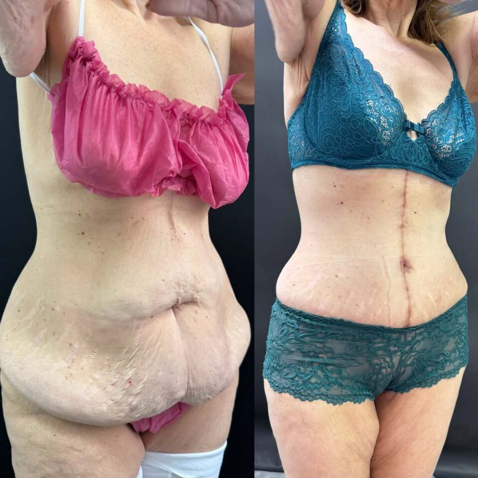 Пластика живота после бариатрической операции, фотография 7