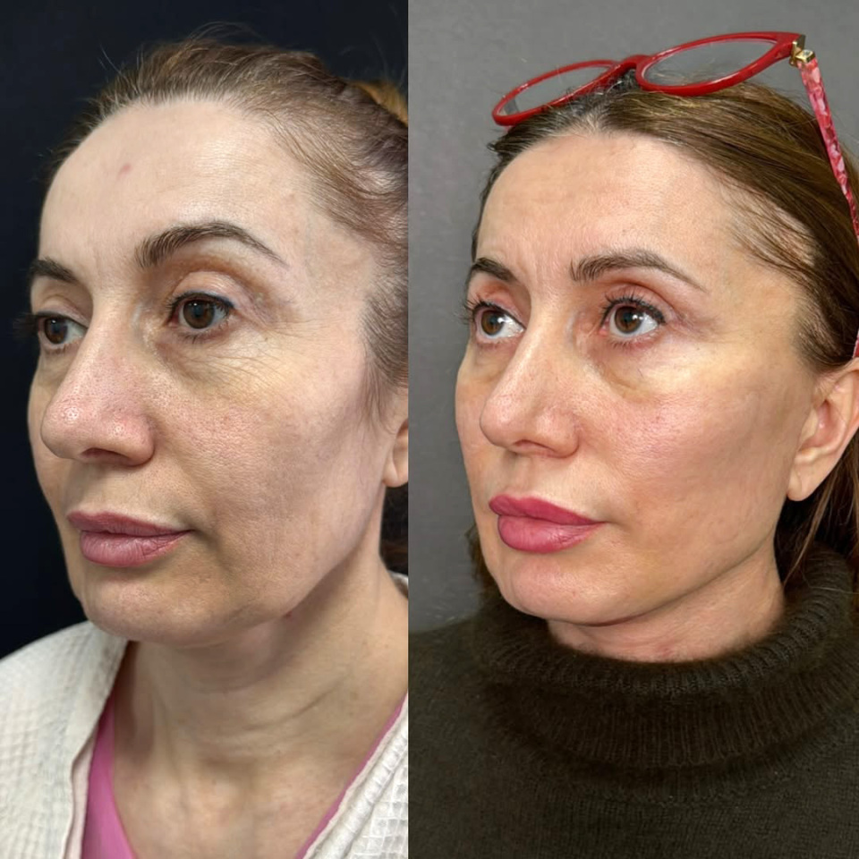 Фейслифтинг, до и после, фотография 1