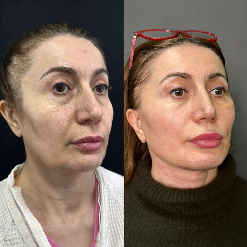 Фейслифтинг, до и после, фотография 2