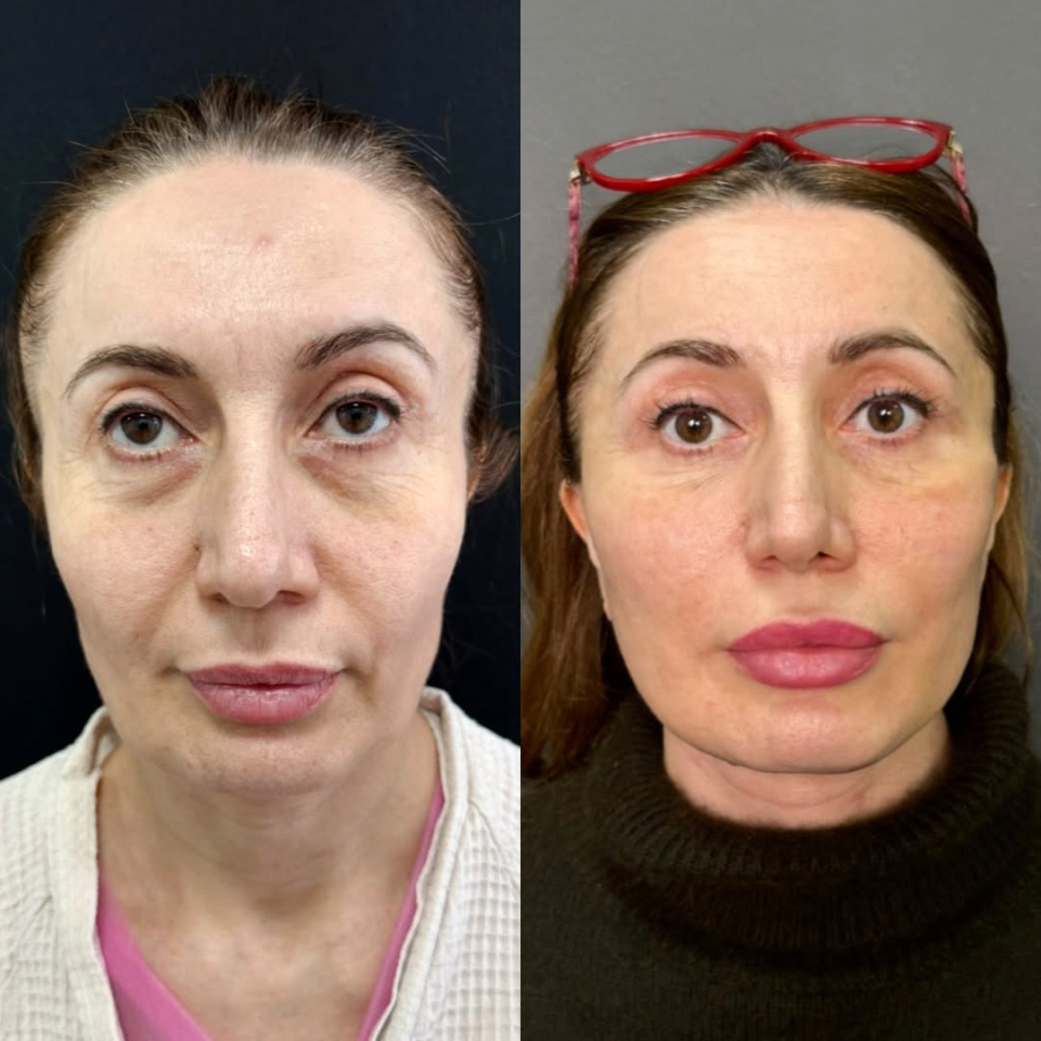 Фейслифтинг, до и после, фотография 3