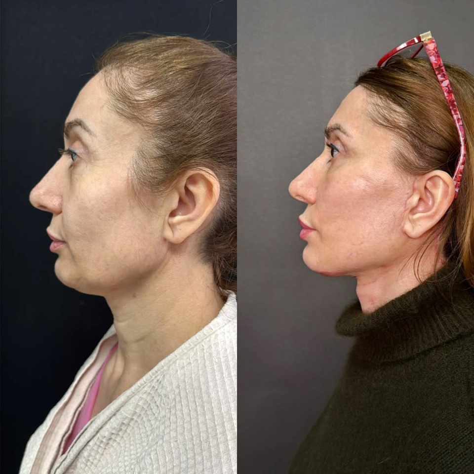 Фейслифтинг, до и после, фотография 4