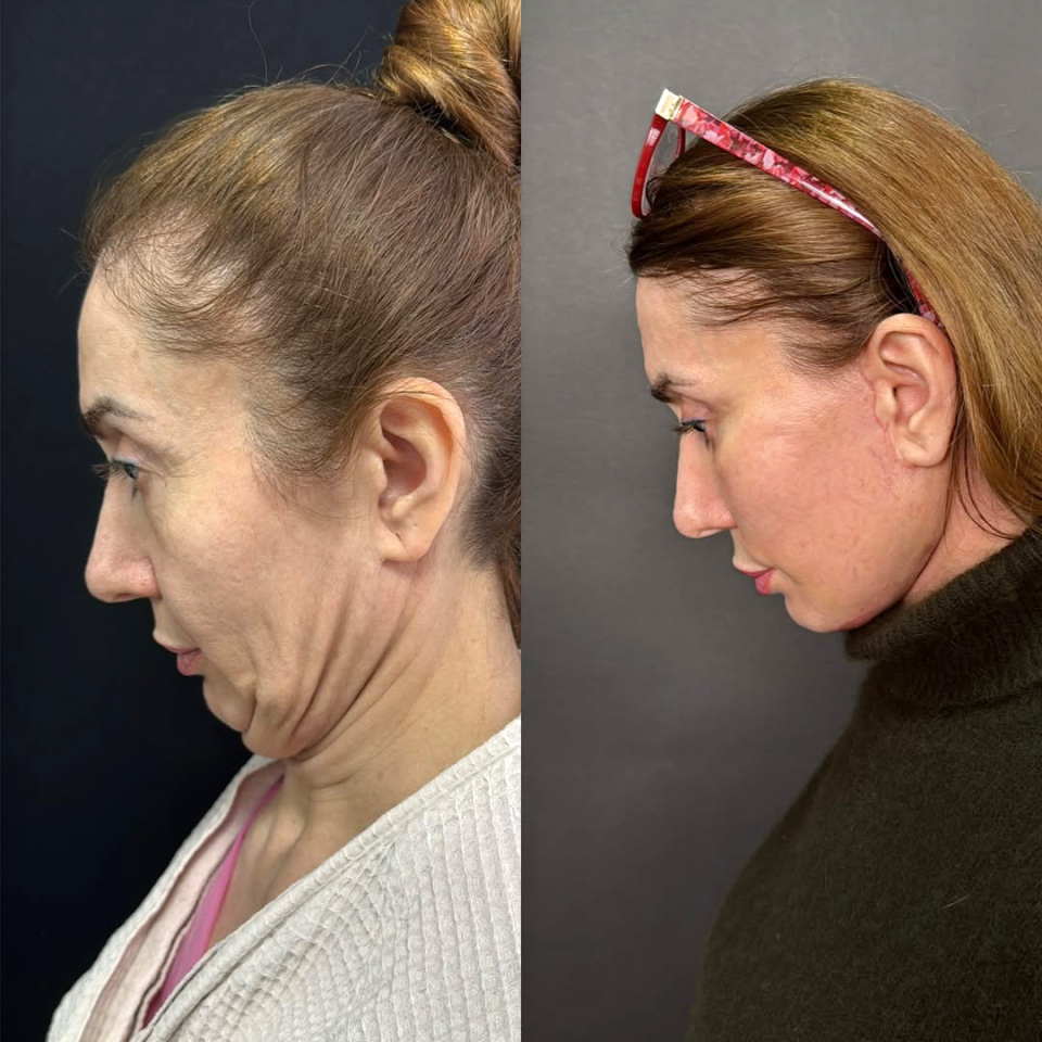 Фейслифтинг, до и после, фотография 5