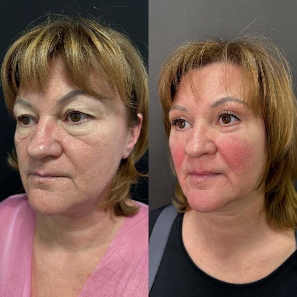 Убрать мешки под глазами, фотография 1