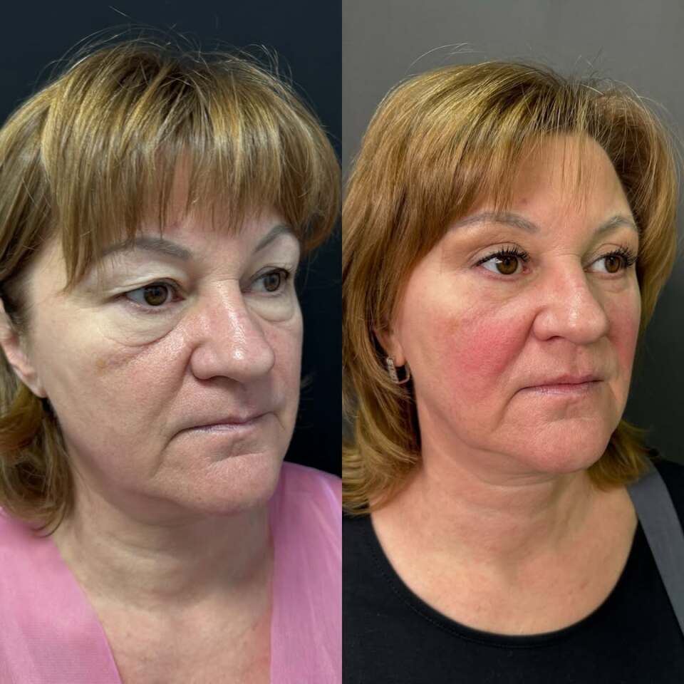 Убрать мешки под глазами, фотография 2