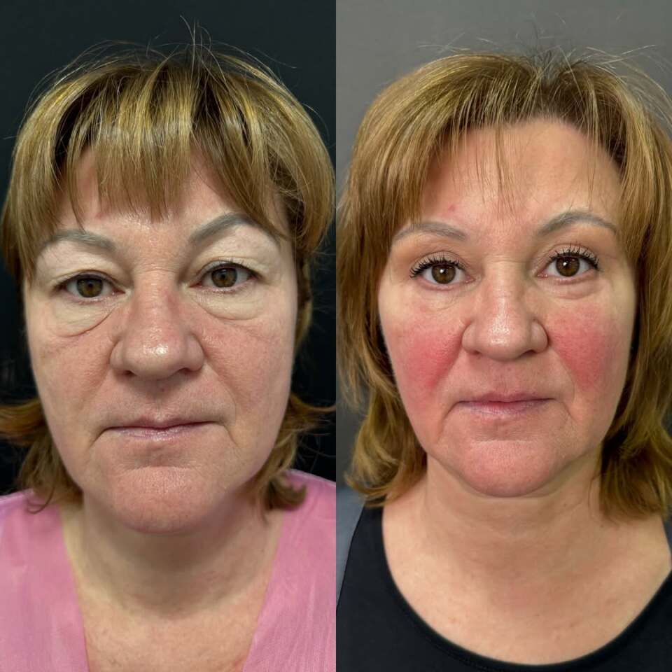 Убрать мешки под глазами, фотография 3