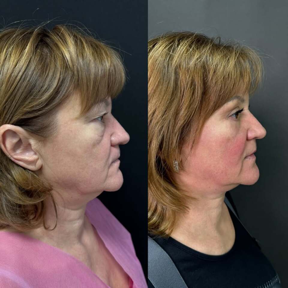 Убрать мешки под глазами, фотография 4