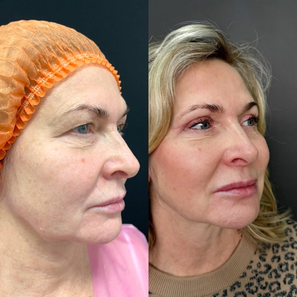 Пластика верхних век, фотография 1