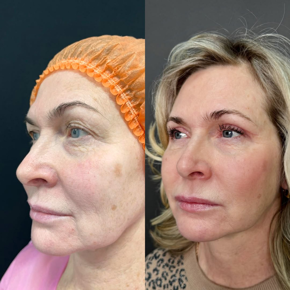 Пластика верхних век, фотография 2