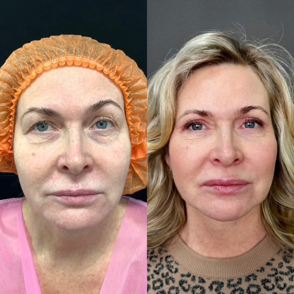 Пластика верхних век, фотография 3