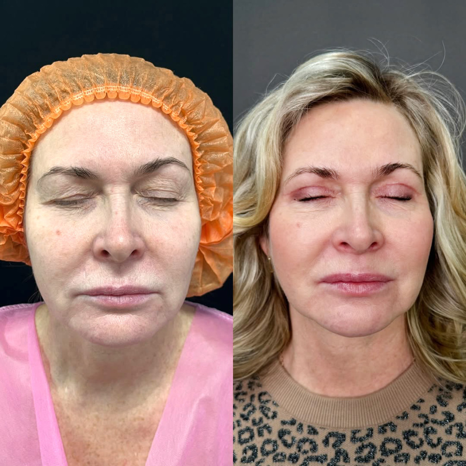 Пластика верхних век, фотография 4