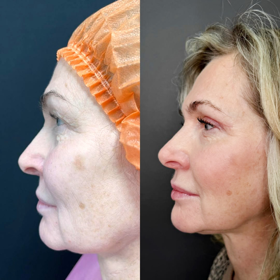 Пластика верхних век, фотография 5