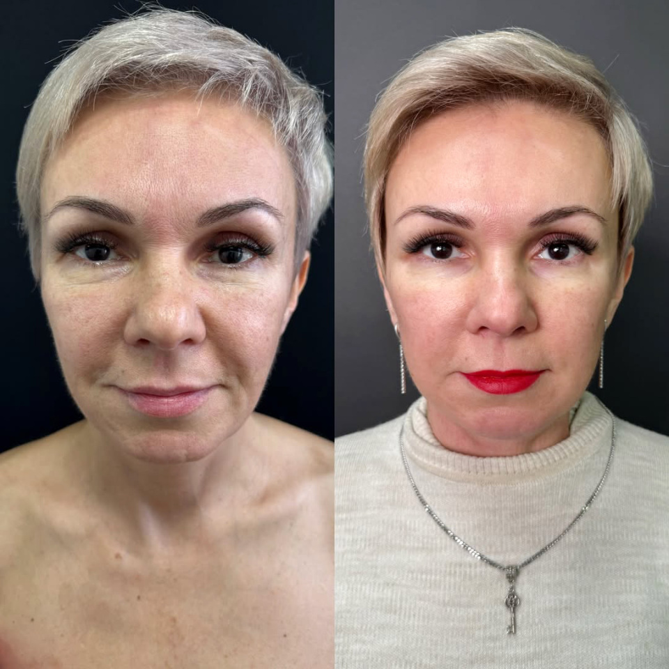 Повторный фейслифтинг, результат, фотография 1