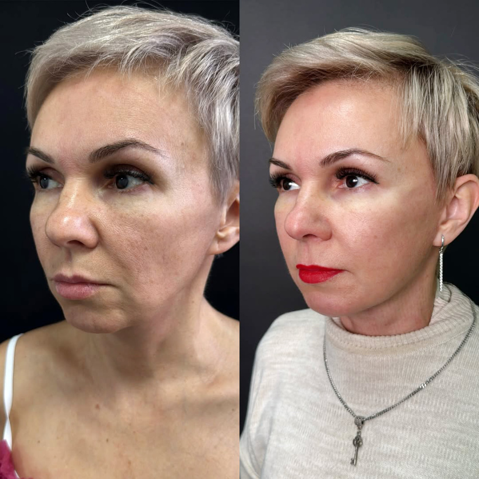 Повторный фейслифтинг, результат, фотография 2