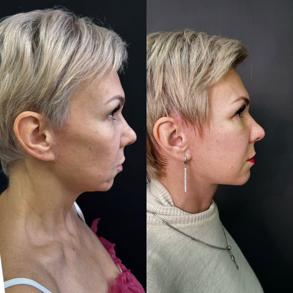 Повторный фейслифтинг, результат, фотография 4