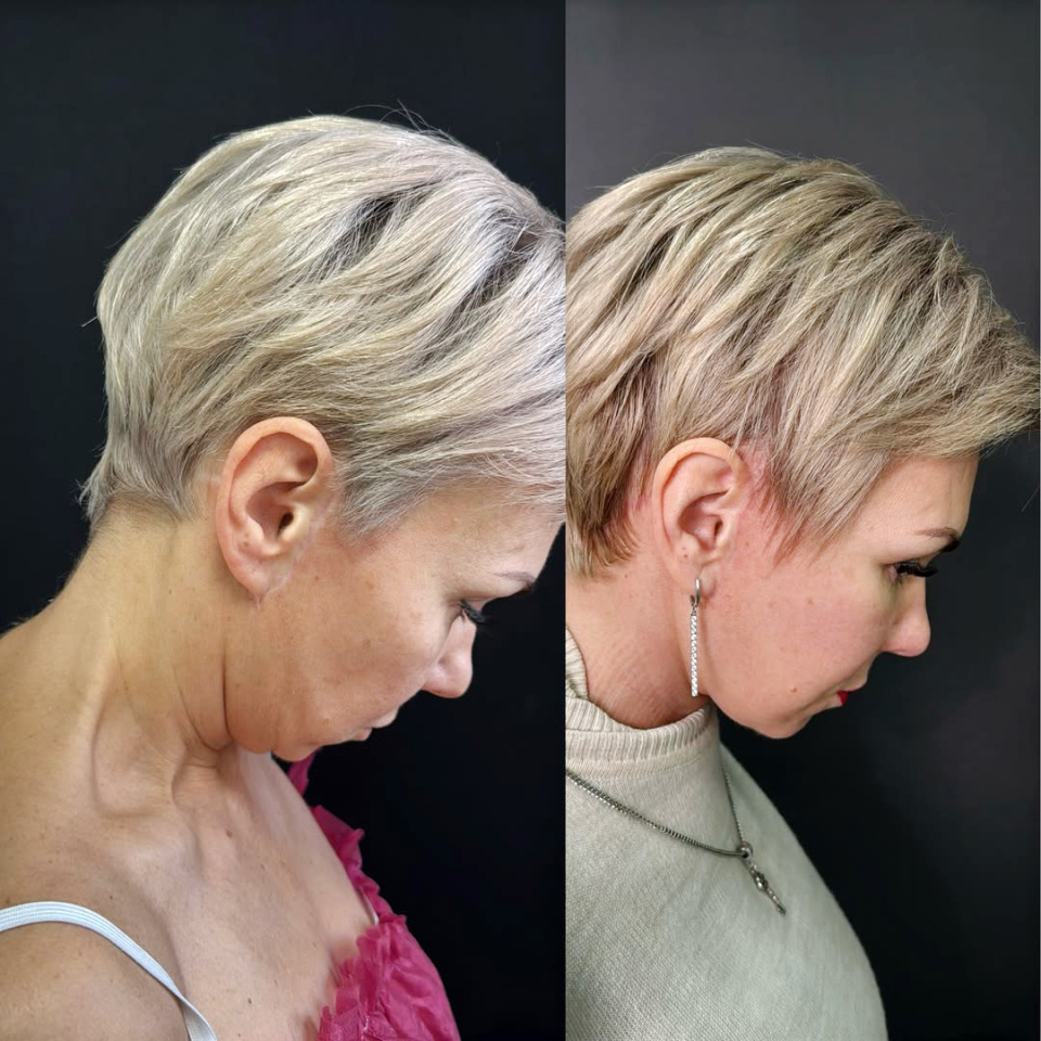 Повторный фейслифтинг, результат, фотография 5