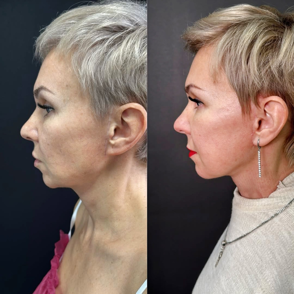 Повторный фейслифтинг, результат, фотография 6