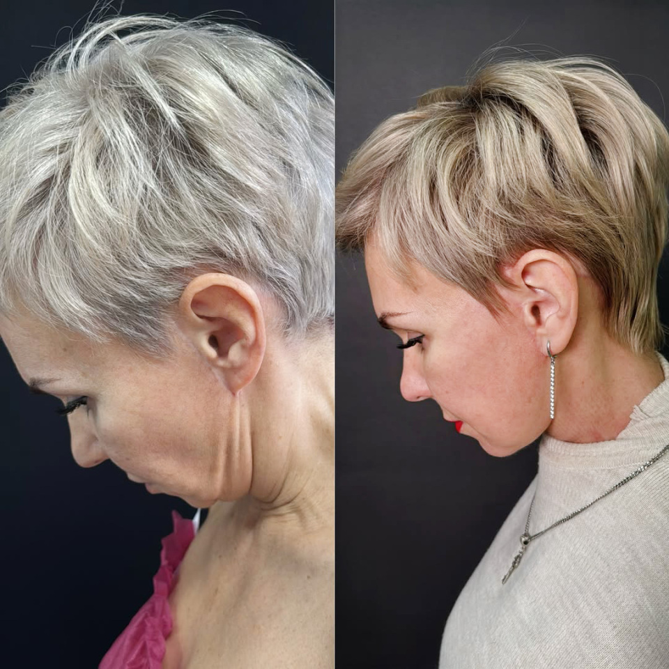 Повторный фейслифтинг, результат, фотография 7