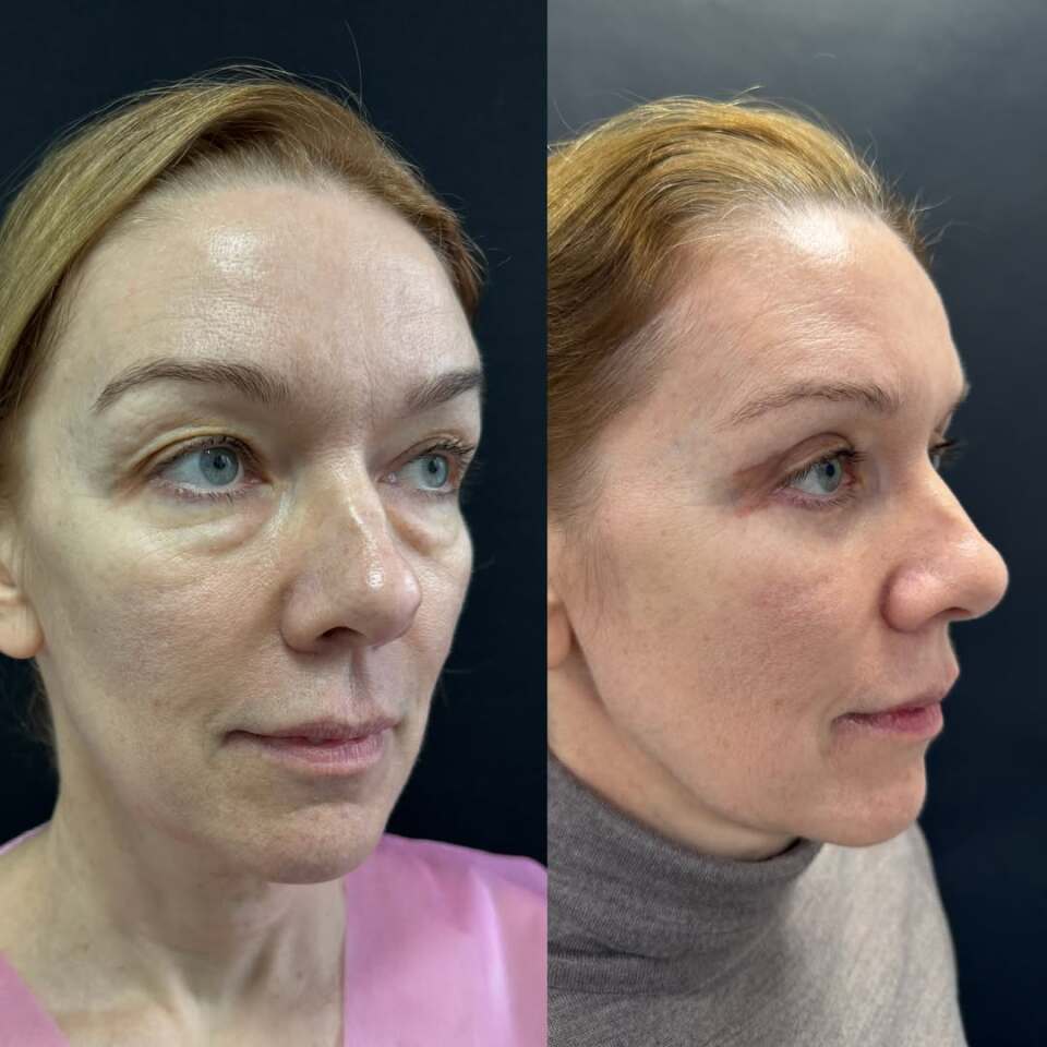 Блефаропластика – операция меняющая все, фотография 1