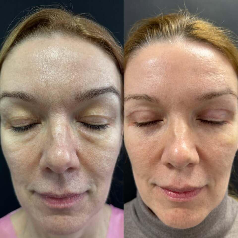 Блефаропластика – операция меняющая все, фотография 2