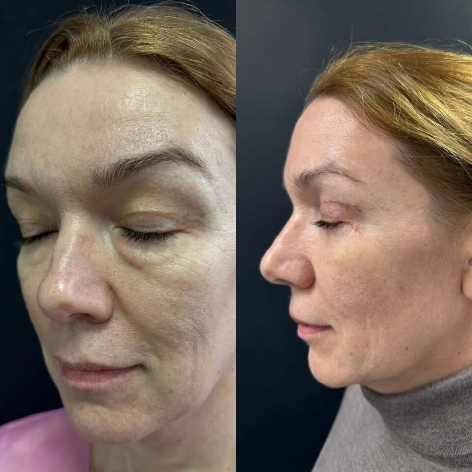 Блефаропластика – операция меняющая все, фотография 3