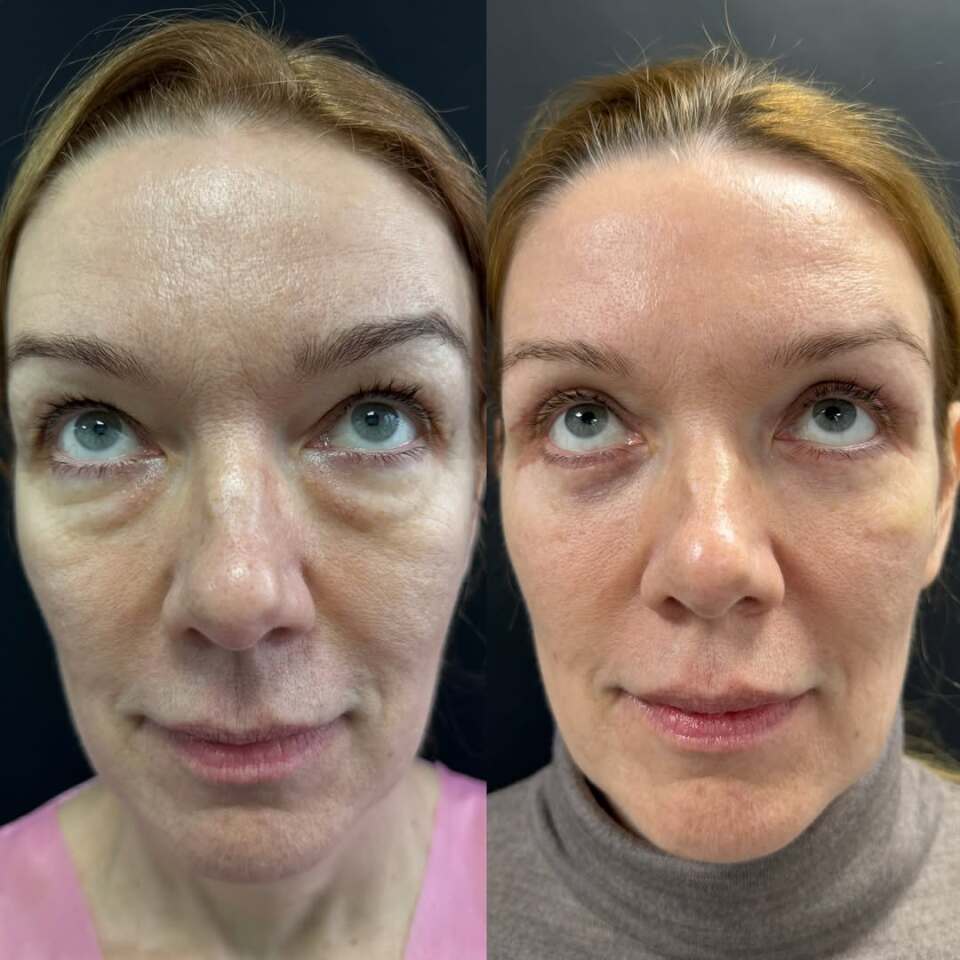 Блефаропластика – операция меняющая все, фотография 4