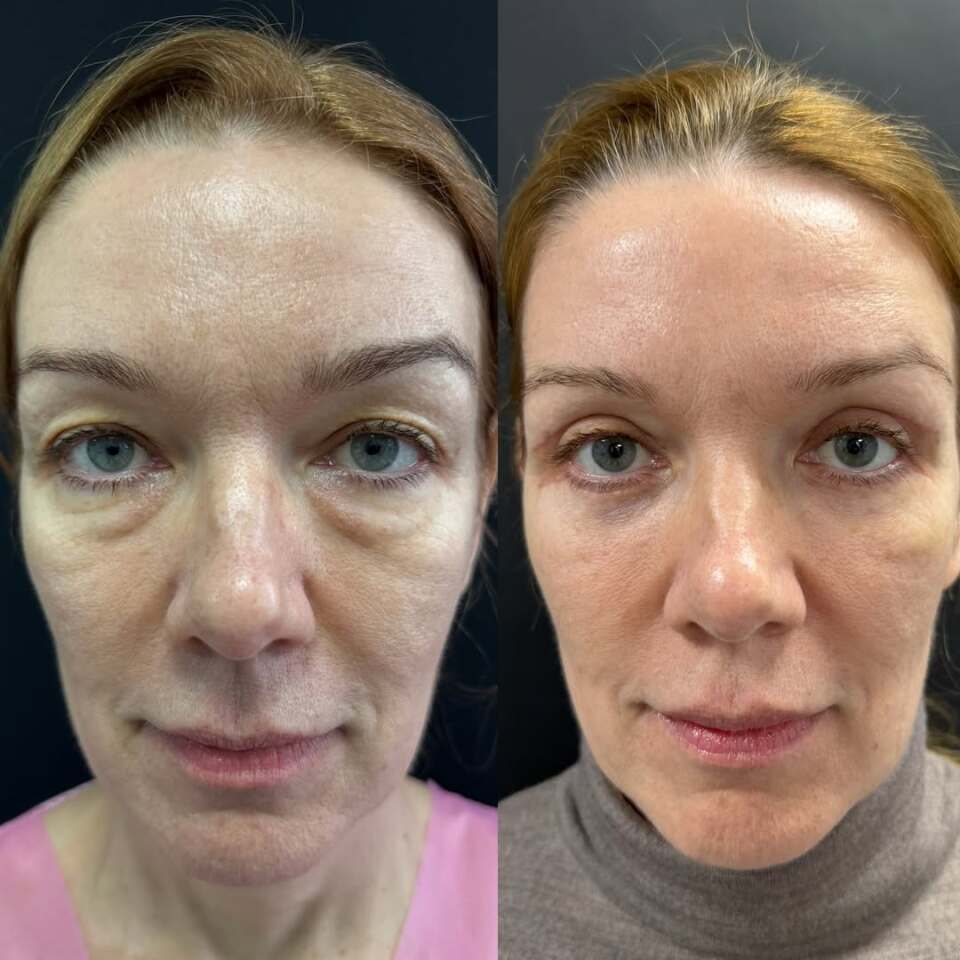 Блефаропластика – операция меняющая все, фотография 5