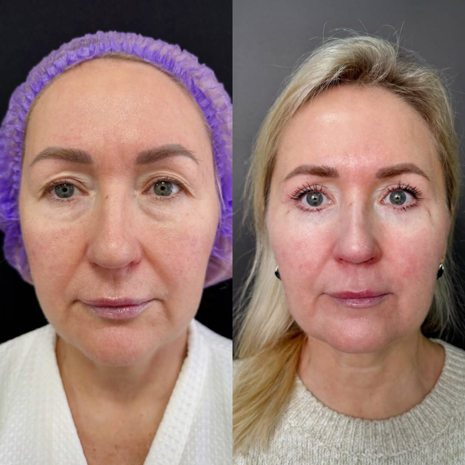 Результат пластики век, фотография 2