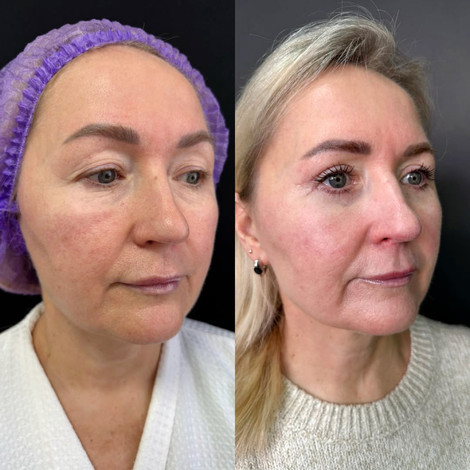 Результат пластики век, фотография 3