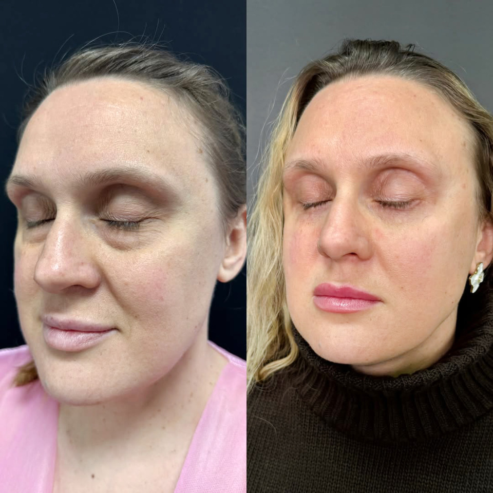 Открытый взгляд после пластики век, фотография 2