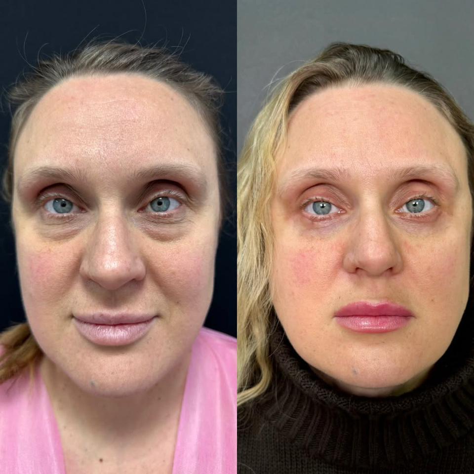 Открытый взгляд после пластики век, фотография 5