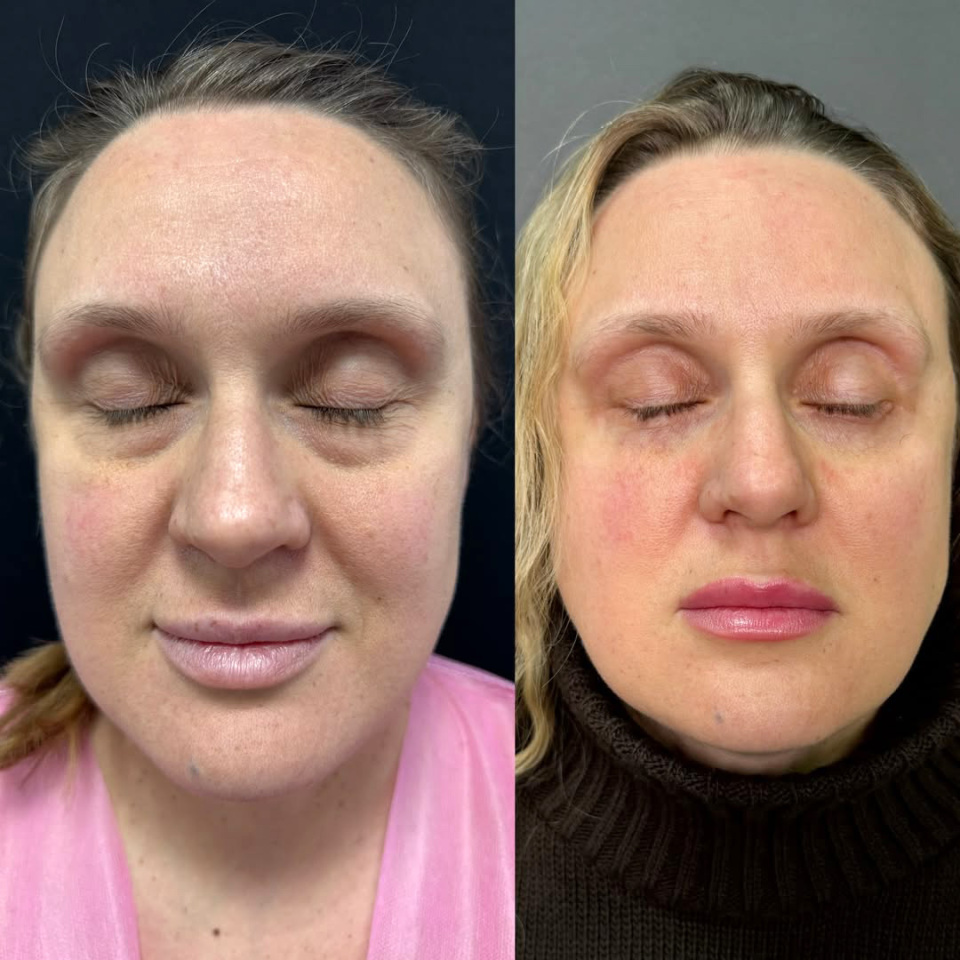 Открытый взгляд после пластики век, фотография 6