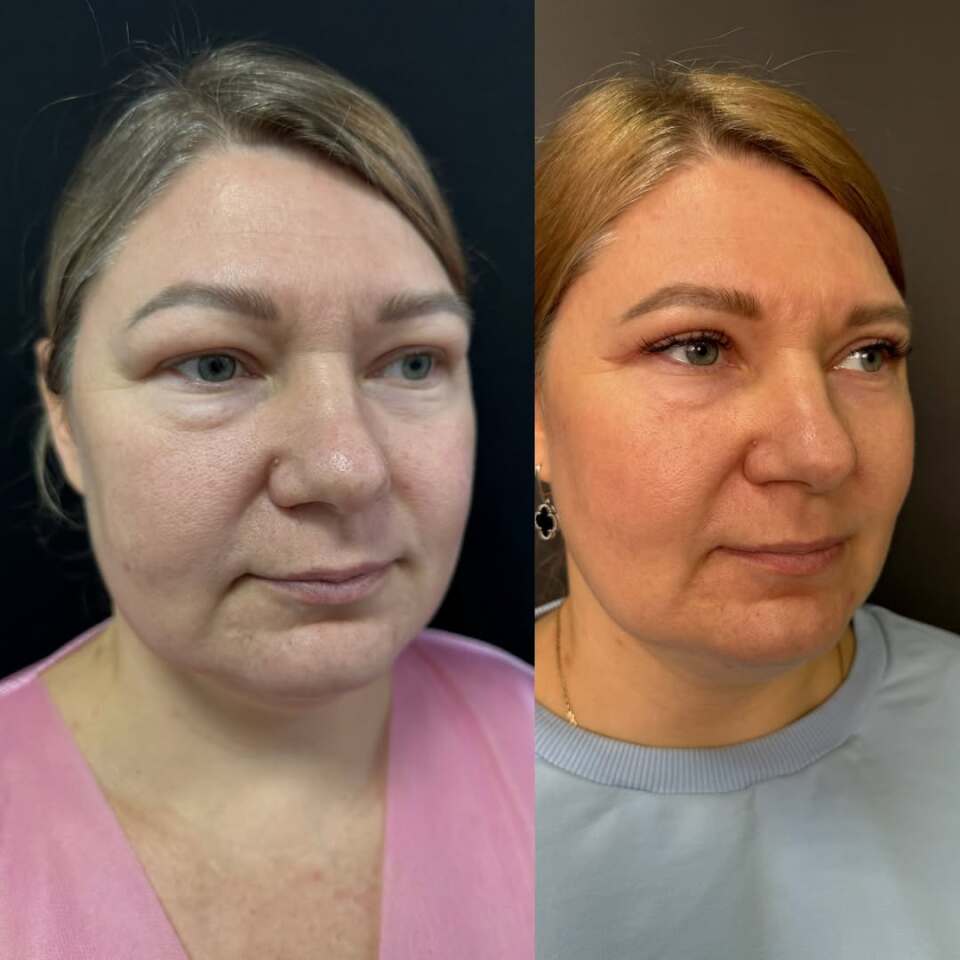 Верхняя блефаропластика, фотография 1