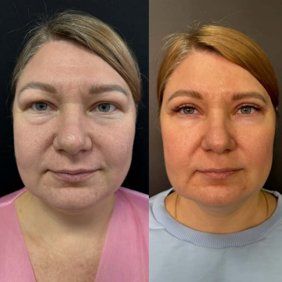 Верхняя блефаропластика, фотография 3