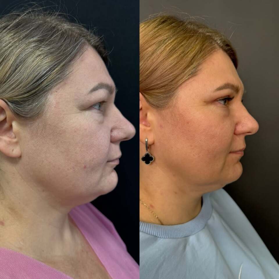 Верхняя блефаропластика, фотография 4