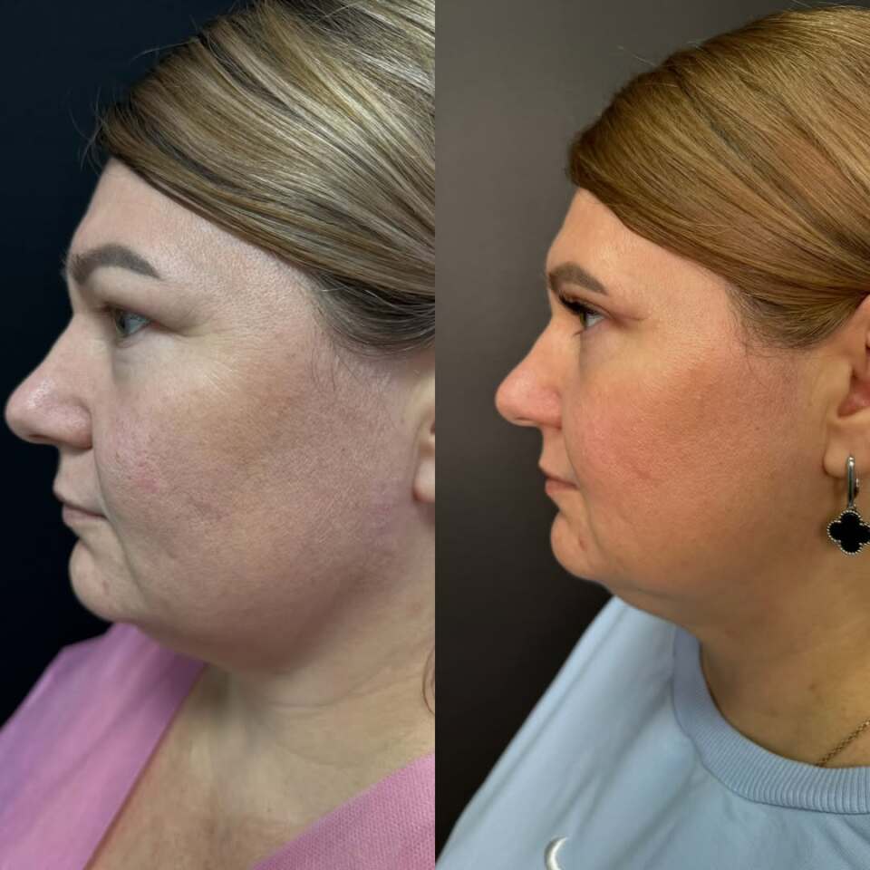 Верхняя блефаропластика, фотография 6