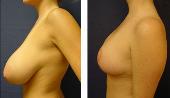 Уменьшение груди (фото до и после)  — хирург Осин М.А. 16.06.2018, фотография 1