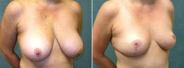 Уменьшение грудных желез  — хирург Осин М.А. 13.02.2018, фотография 1