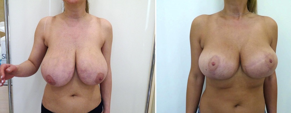 Уменьшение груди  — хирург Осин М.А. 30.09.2019, фотография 1