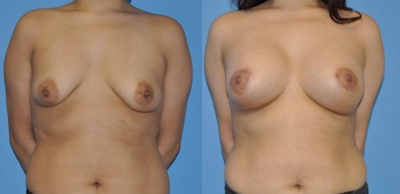 Увеличение груди  — хирург Осин М.А. 18.01.2019, фотография 1