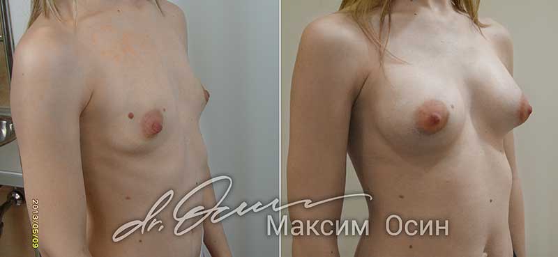 Увеличение груди  — хирург Осин М.А. 19.12.2018, фотография 1