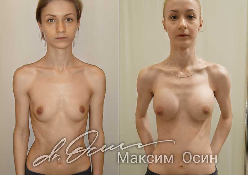 Увеличение груди  — хирург Осин М.А. 22.03.2018, фотография 1