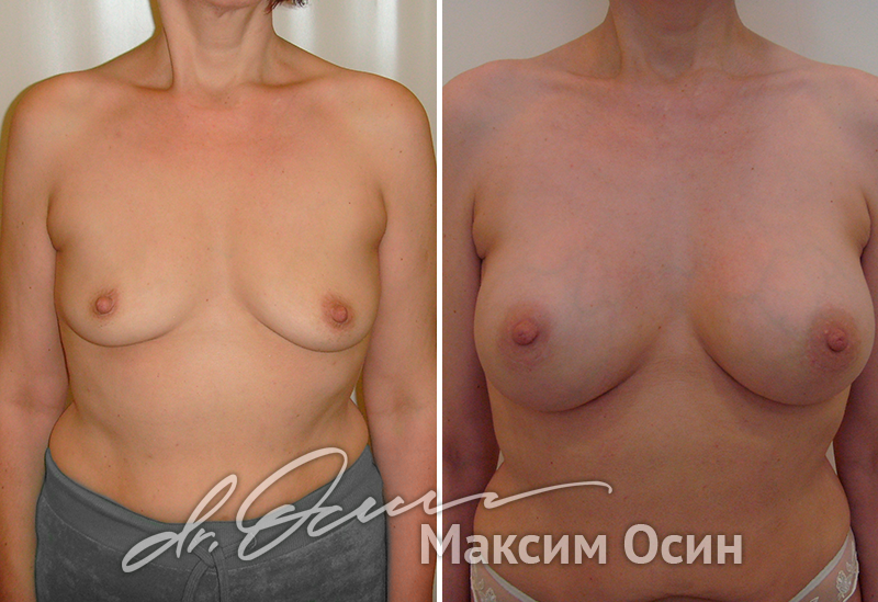 Увеличение груди  — хирург Осин М.А. 06.03.2019, фотография 1