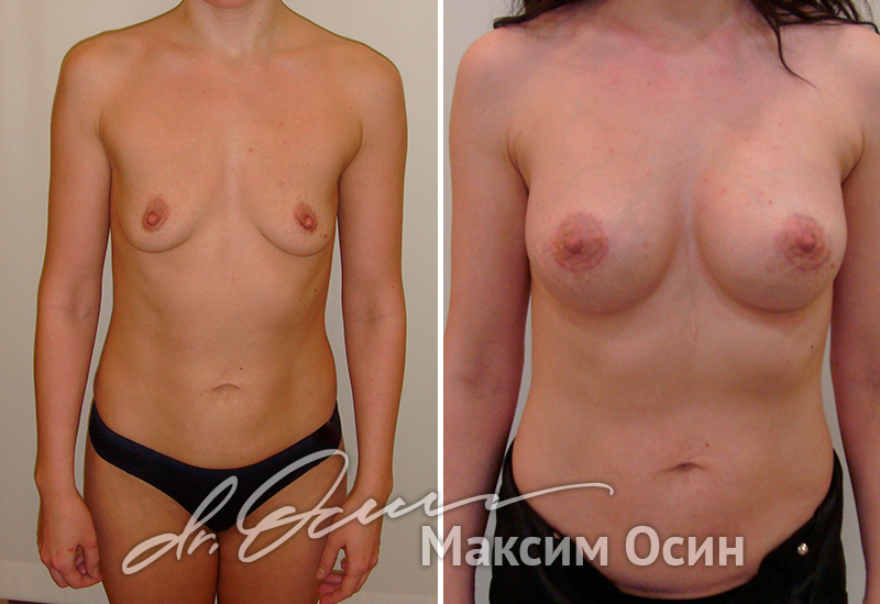 Увеличение груди  — хирург Осин М.А. 31.01.2018, фотография 1