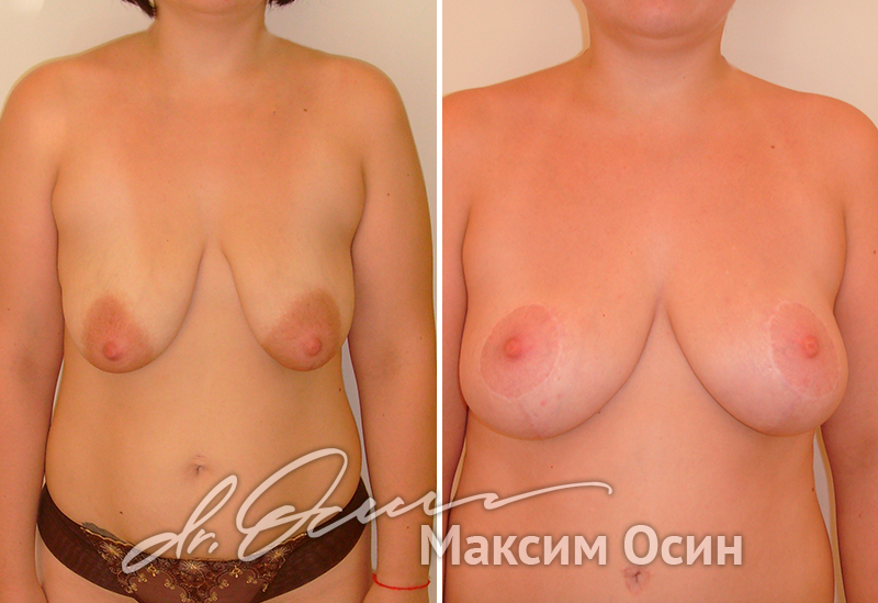 Увеличение груди с подтяжкой  — хирург Осин М.А. 14.01.2019, фотография 1