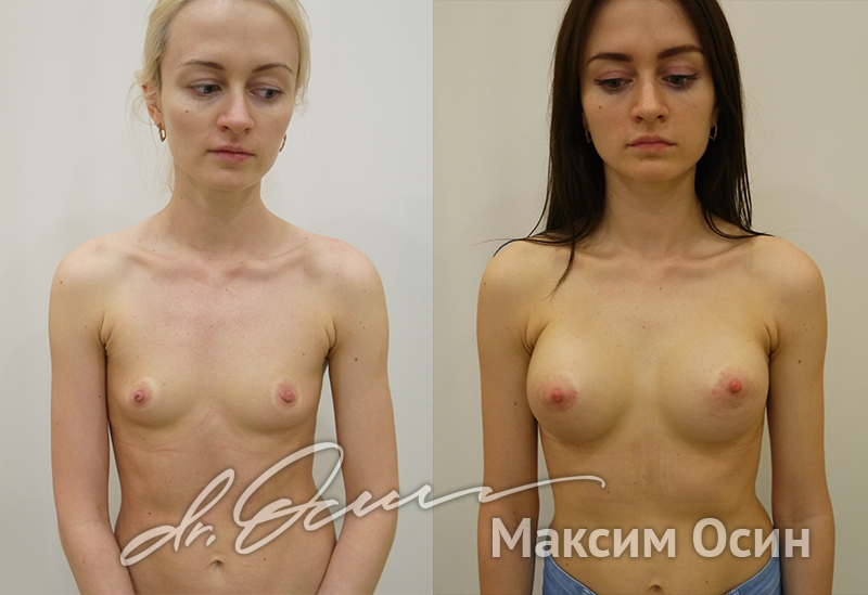 Увеличение груди  — хирург Осин М.А. 09.02.2019, фотография 1