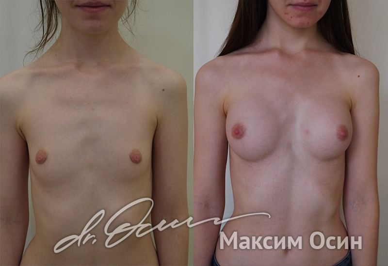 Увеличение груди  — хирург Осин М.А. 31.10.2018, фотография 1
