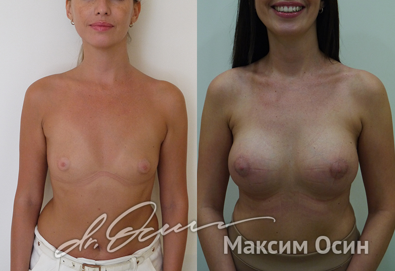 Увеличение груди  — хирург Осин М.А. 18.06.2019, фотография 1