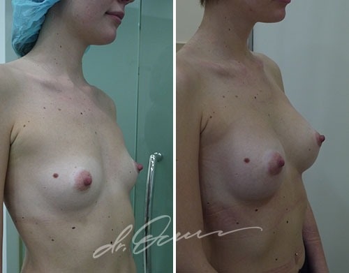 Увеличение груди  — хирург Осин М.А. 14.06.2013, фотография 1